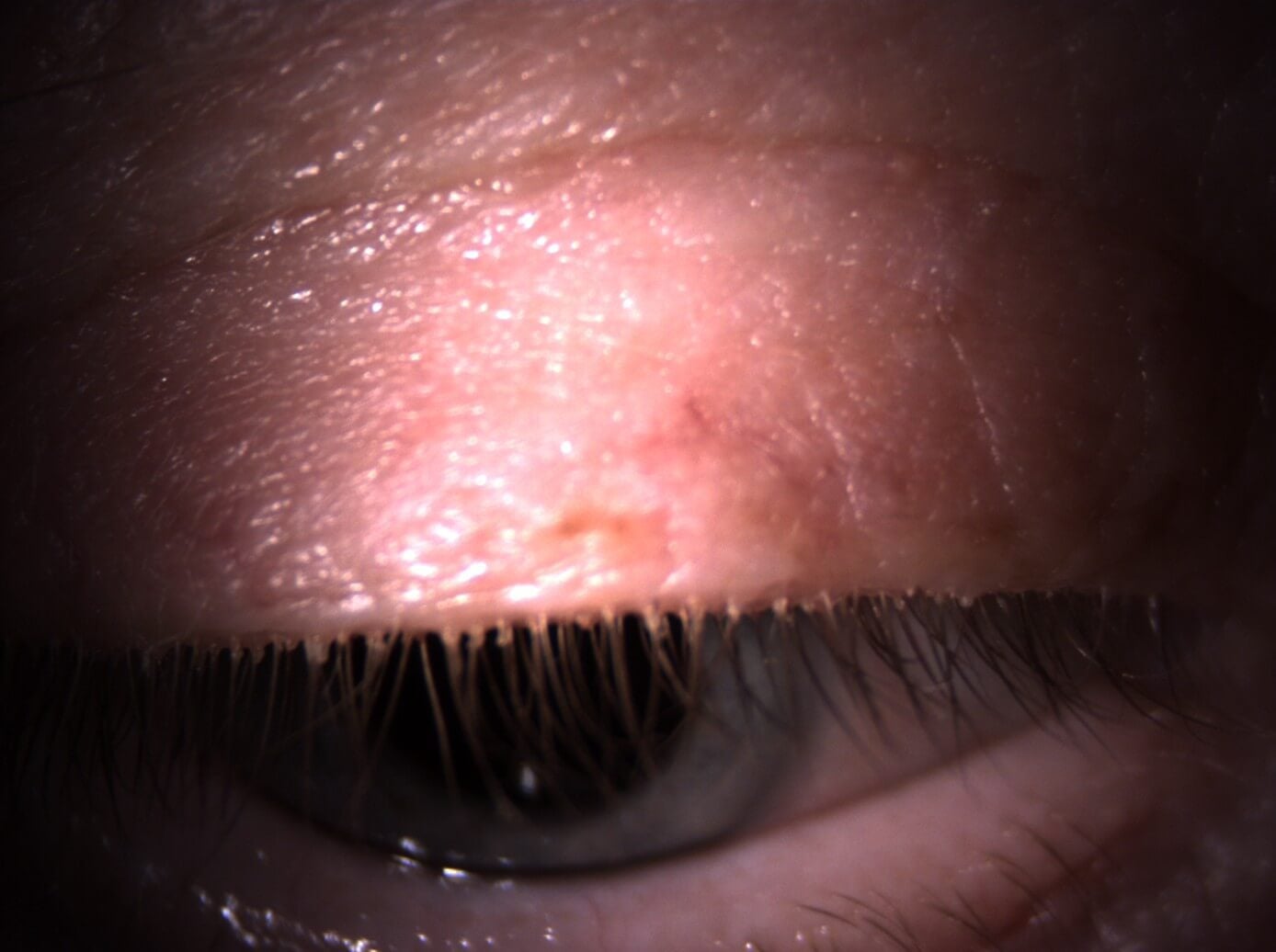 Same patient looking down; collarettes are visible
