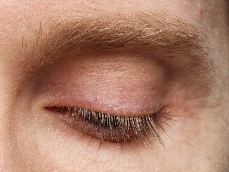 Close up of a male patient's eye. Collarettes are visible.