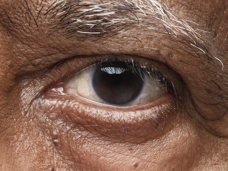 Close up of a male patient's eye