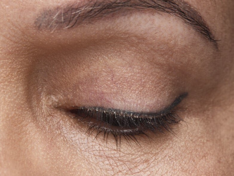 Close up of a female patient's eye. Collarettes are visible.